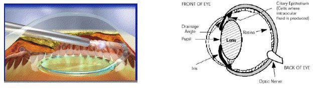 New Endolaser (ECP) Treatment for Canine Glaucoma | Veterinarian and ...